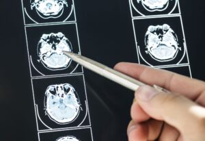 worsening symptoms after stroke