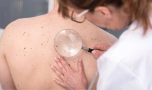 late stage melanoma treatment